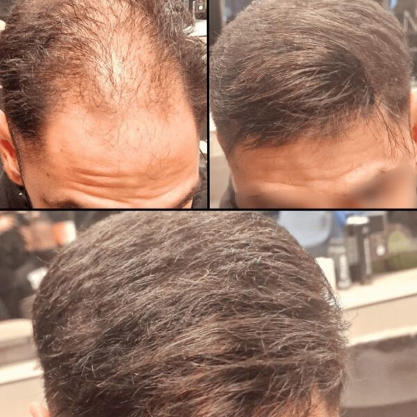 Εφαρμογή Περουκίνη σε άντρα 2